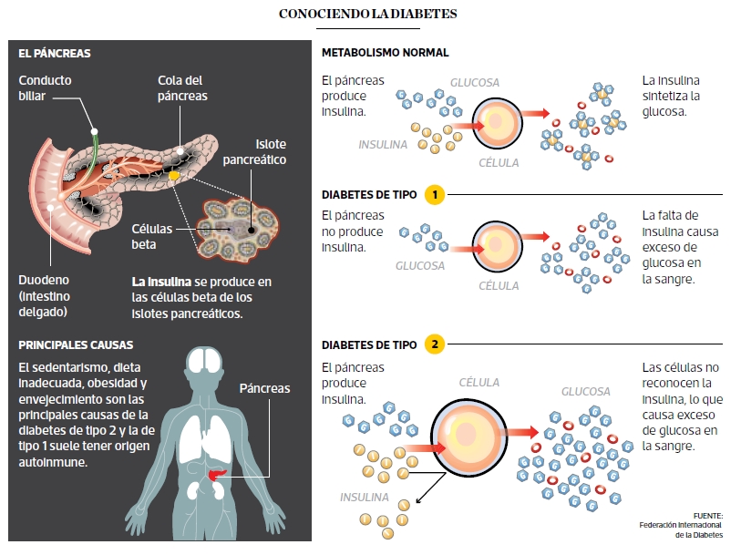 ¿Una vacuna contra la diabetes tipo 1?