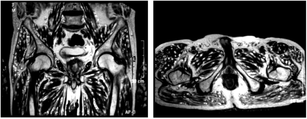 Resonancia magnética nuclear de pelvis. Corte