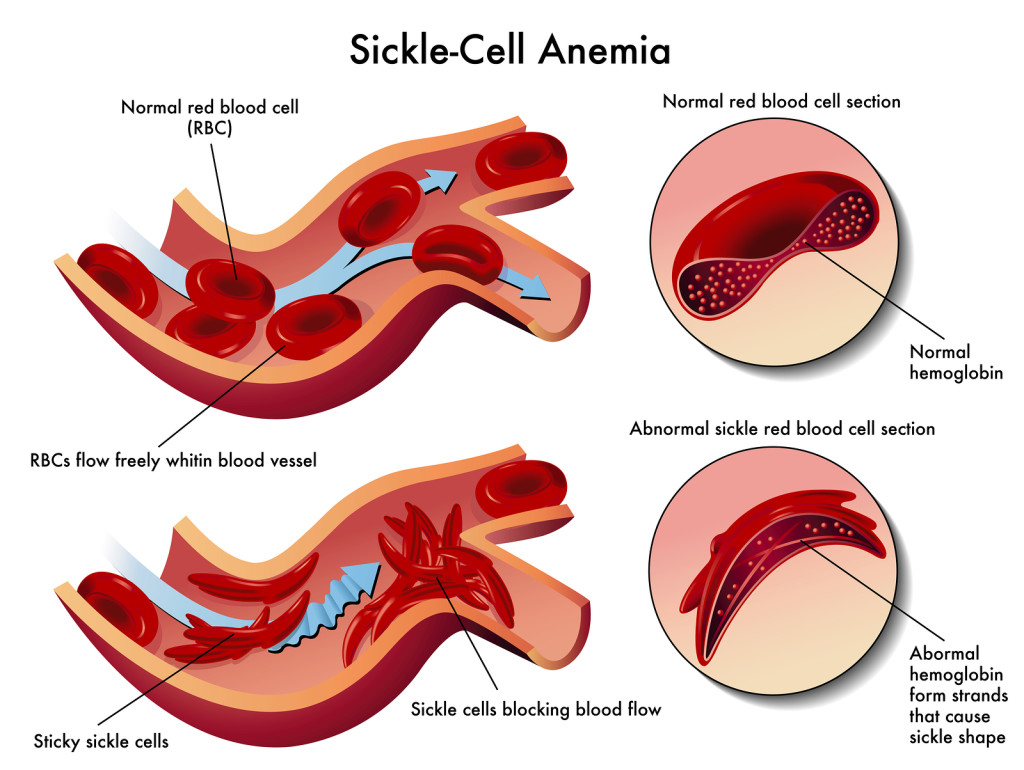 Anemia de células falciformes. Fuente.