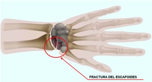 Blog Fractura escafoides